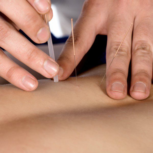 Acupuncture