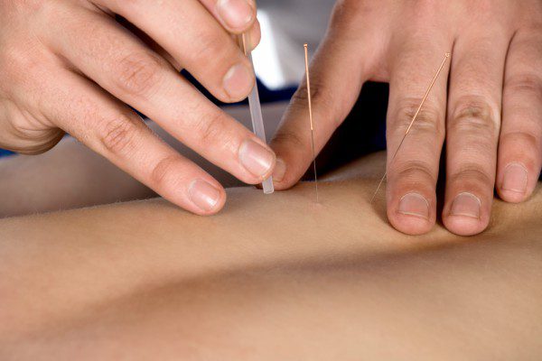 Acupuncture
